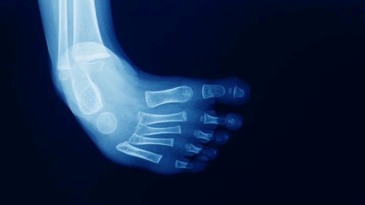 » Pie Equino Varo Congénito Tratamiento mediante fisioterapia