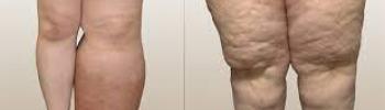 Linfedema y Lipedema: Diferencias y Similitudes en su Tratamiento Linfedema y Lipedema: Diferencias y Similitudes en su Tratamiento