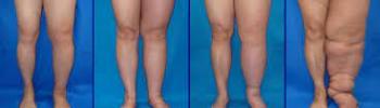 Linfedema Linfedema