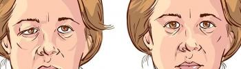 Parálisis facial periférica