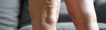 Tratamientos de fisioterapia para mejorar la trombosis venosa