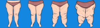 lipedema y obesidad