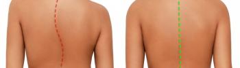 Quiropraxia y fisioterapia combinadas en escoliosis leve excluyendo cirugía
