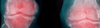 Tratamiento mediante la fisioterapia para la artrosis de rodilla y cadera - FisioClinics Bilbao Tratamiento mediante la fisioterapia para la artrosis de rodilla y cadera - FisioClinics Bilbao