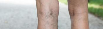 varices FisioClinics Bilbao
