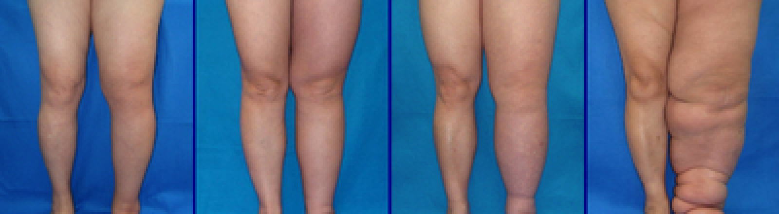 Fisioterapia linfedema