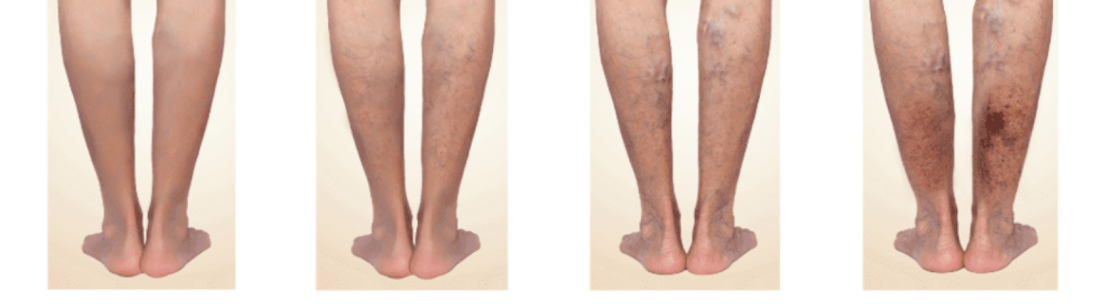 Fisioterapia varices bilbao