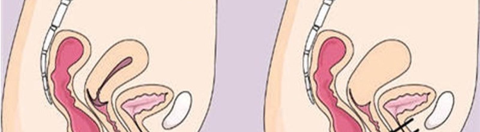 Vaginismo Vaginismo