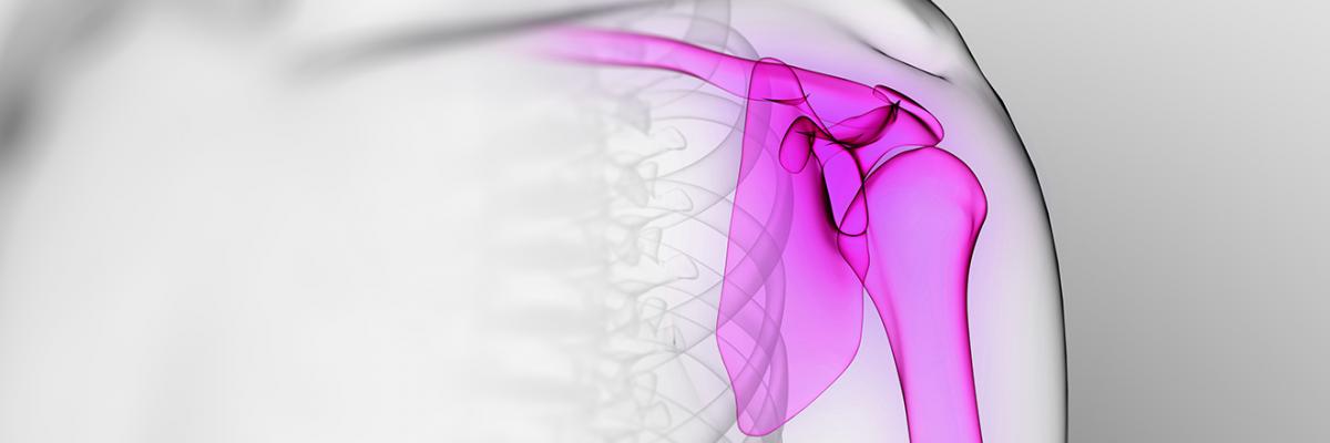 Capsulitis adhesiva