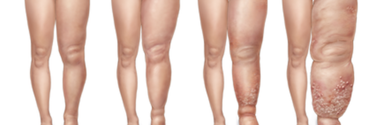 linfedema primario y secundario