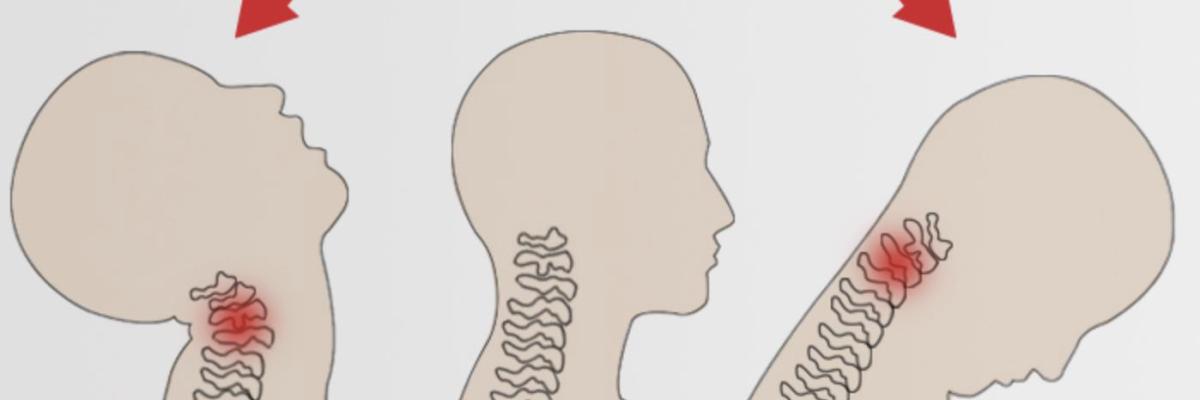 esguince cervical