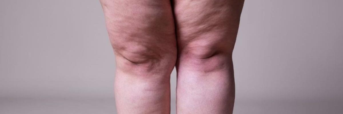 Lipedema piernas Lipedema piernas