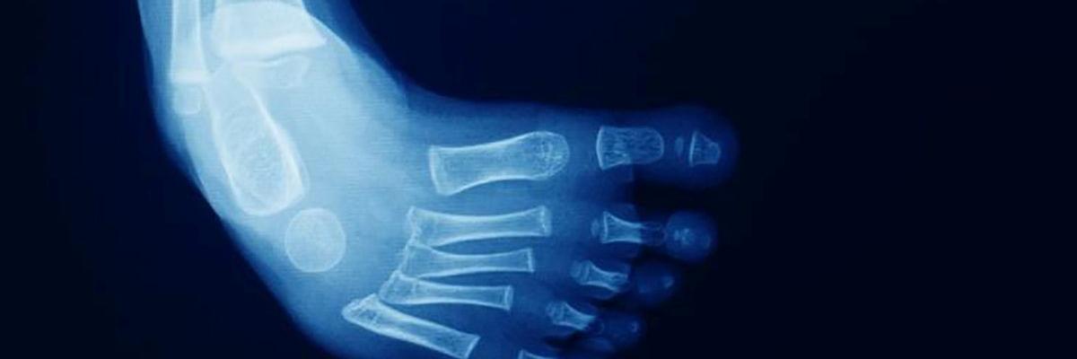 Pie Equino Varo Congénito: Tratamiento mediante fisioterapia - FisioClinics Bilbao
