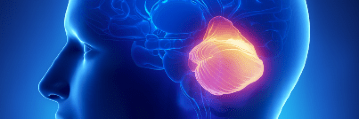Ataxia cerebelosa: Qué es, causas, síntomas y tratamiento a través de la fisioterapia neurológica.