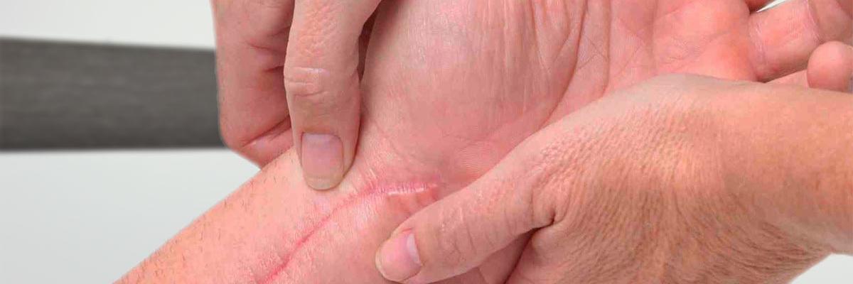 Tratamiento de las cicatrices mediante la técnica indiba - FisioClinics Bilbao
