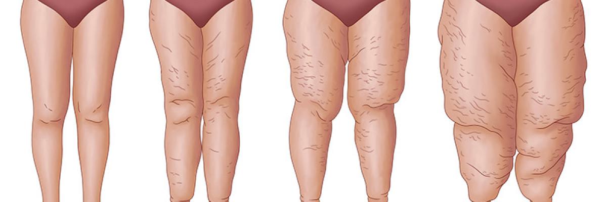 Diagnóstico de Lipedema en Bilbao