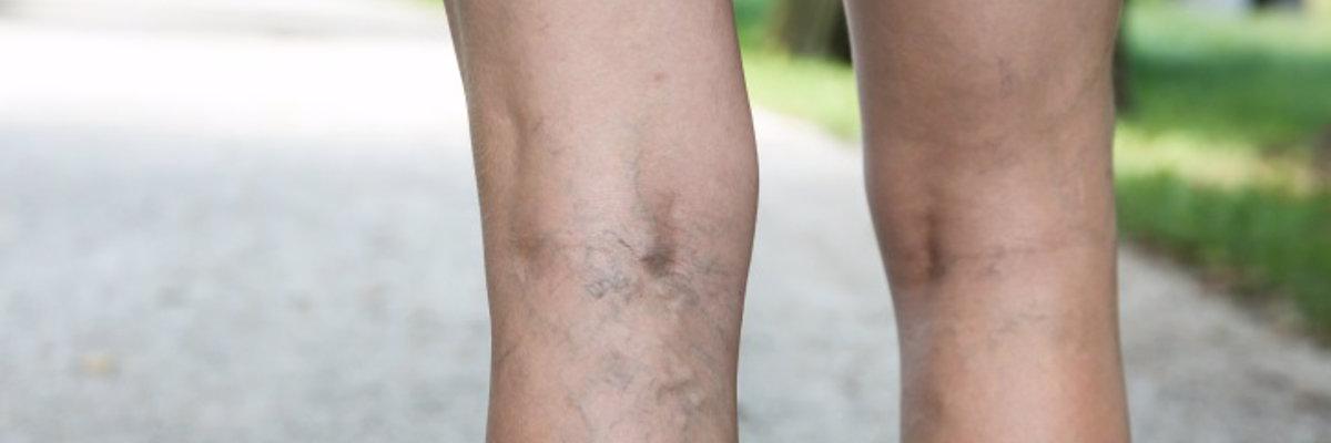 Arañas Vasculares: Tratamiento a través del Drenaje Linfático Manual 