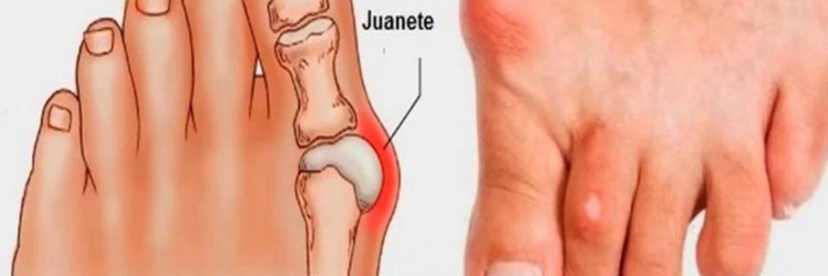 Tratamiento para el Hallux Valgus