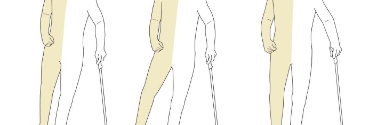 Hemiplejia tras ictus: claves para la recuperación funcional desde la fisioterapia