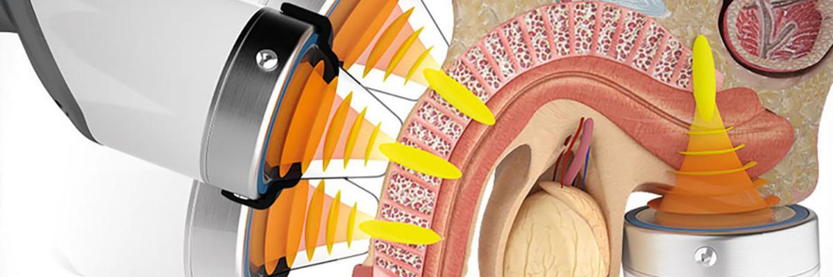 Ondas de choque de baja intensidad 