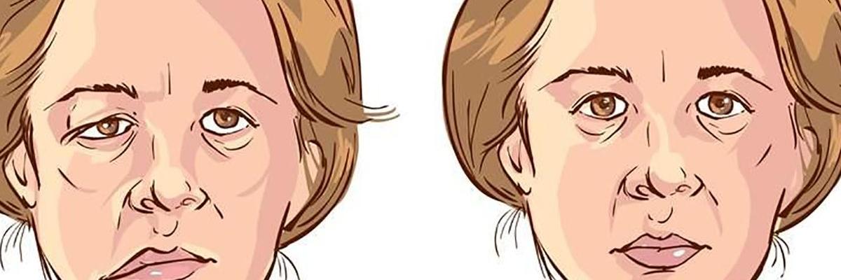 Parálisis facial periférica