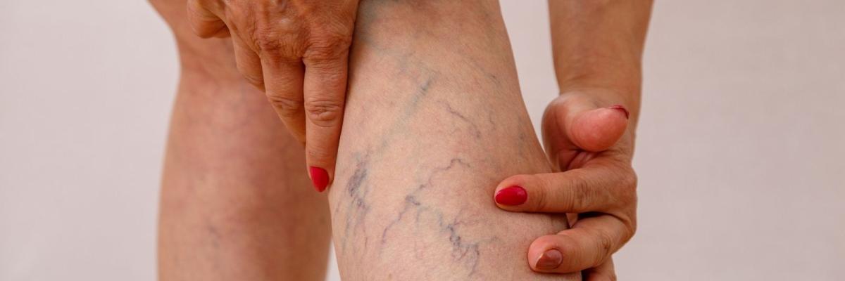 Problemas de circulación y varices: soluciones desde la fisioterapia