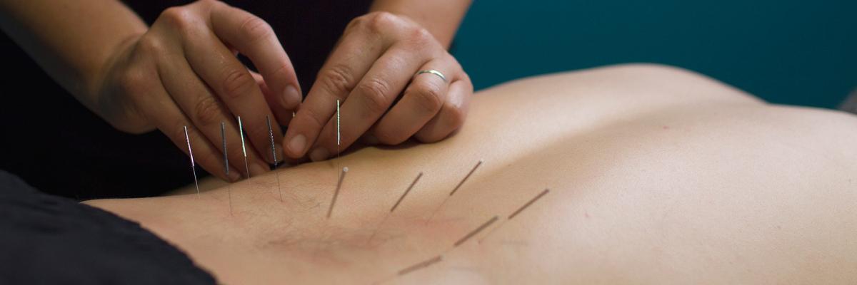 Punción seca para el tratamiento del síndrome piramidal