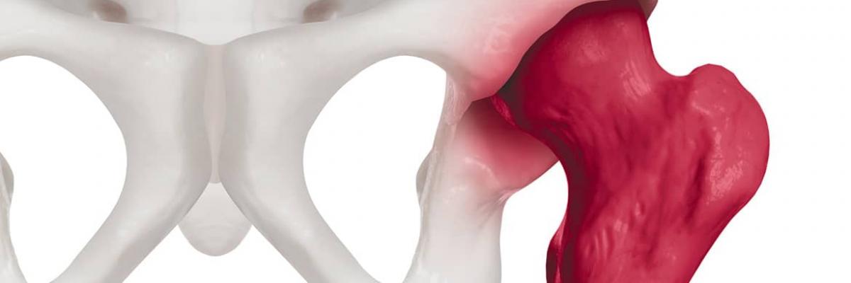 Aplicación de Indiba en el tratamiento de artrosis de cadera- FisioClinics Bilbao