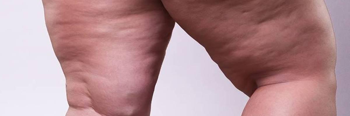 Drenaje linfático manual en el tratamiento del lipedema